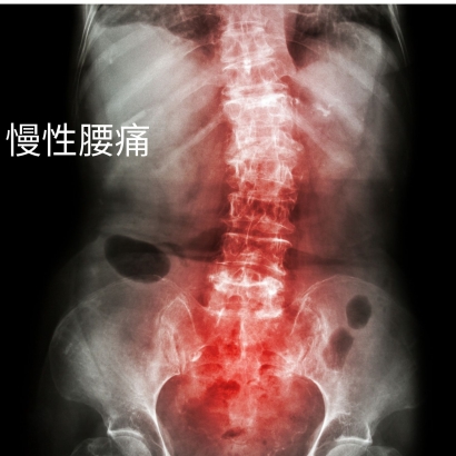 慢性腰痛