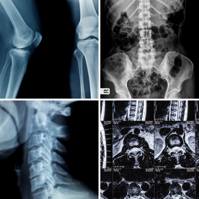 脊椎痠痛診斷需要更多檢查嗎